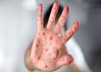 ثبت تاکنون ۴ مورد ابتلا به سرخک در یزد/تردید در واکسیناسیون عامل طغیان سرخک
