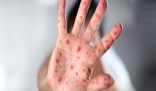 ثبت تاکنون ۴ مورد ابتلا به سرخک در یزد/تردید در واکسیناسیون عامل طغیان سرخک